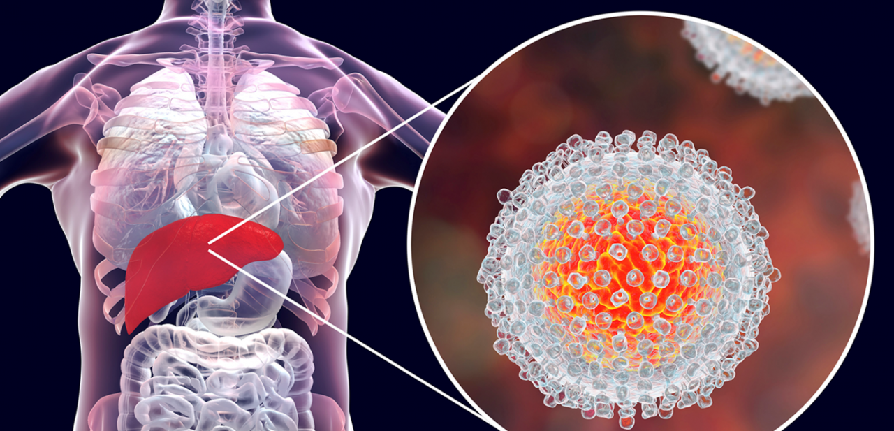 اعراض التهاب الكبد الفيروسي , امراض الكبد واعراضها