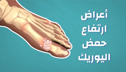 اعراض ارتفاع حمض البول , زيادة مادة اليوريك