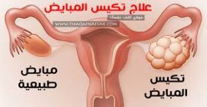 الجديد في علاج تكيسات المبايض