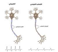 لمرضى التصلب الويحي المتعدد