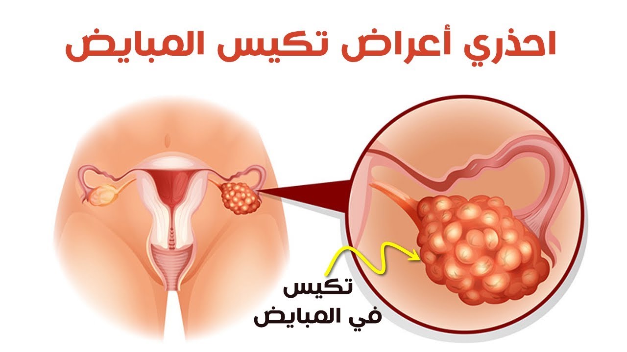 علاج تكيس المبايض بالاعشاب , احذري تكيس المبايض