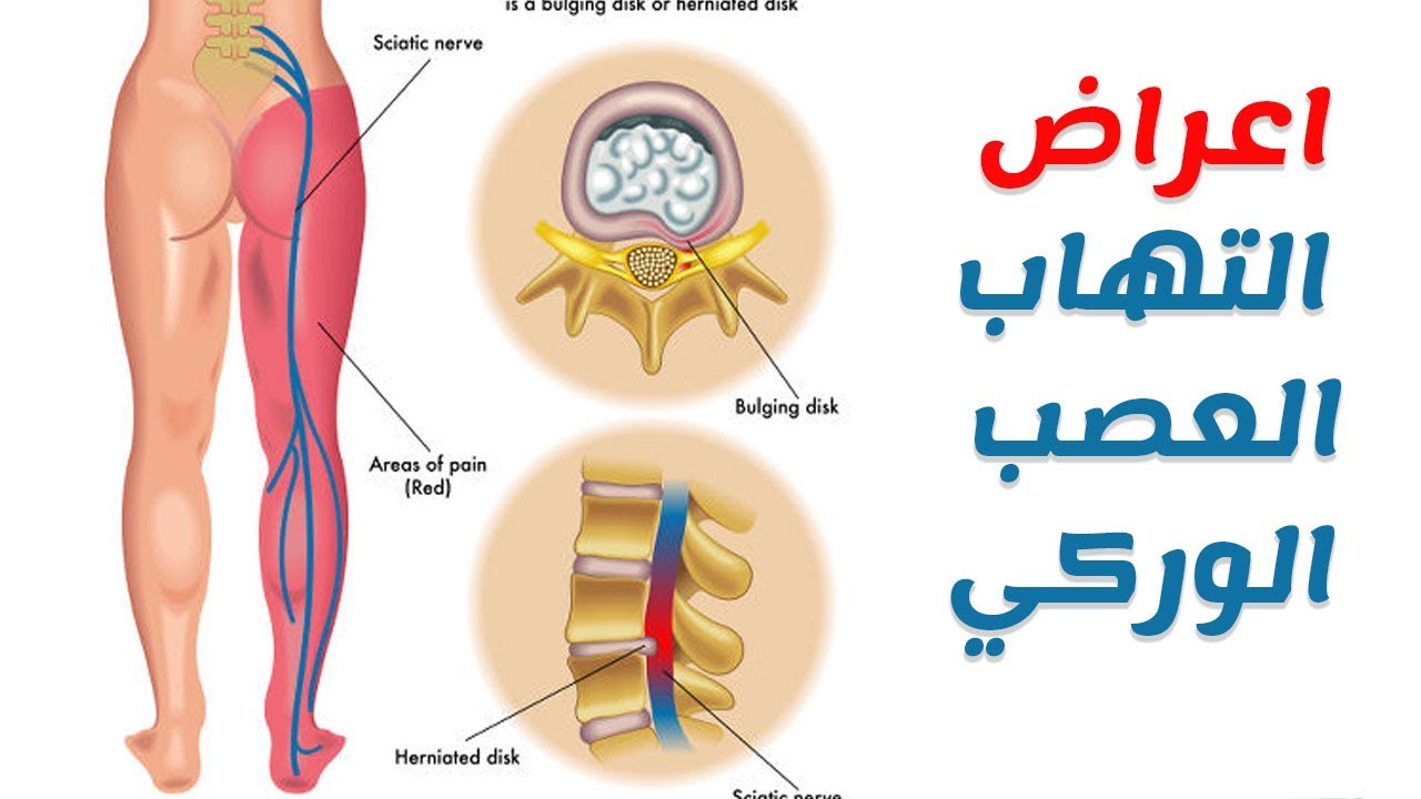 طرق علاج العصب الوركي , طريقة التخلص من الالم الفخذ