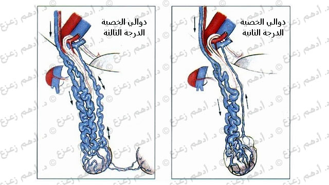 درجات دوالي الخصية بالصور